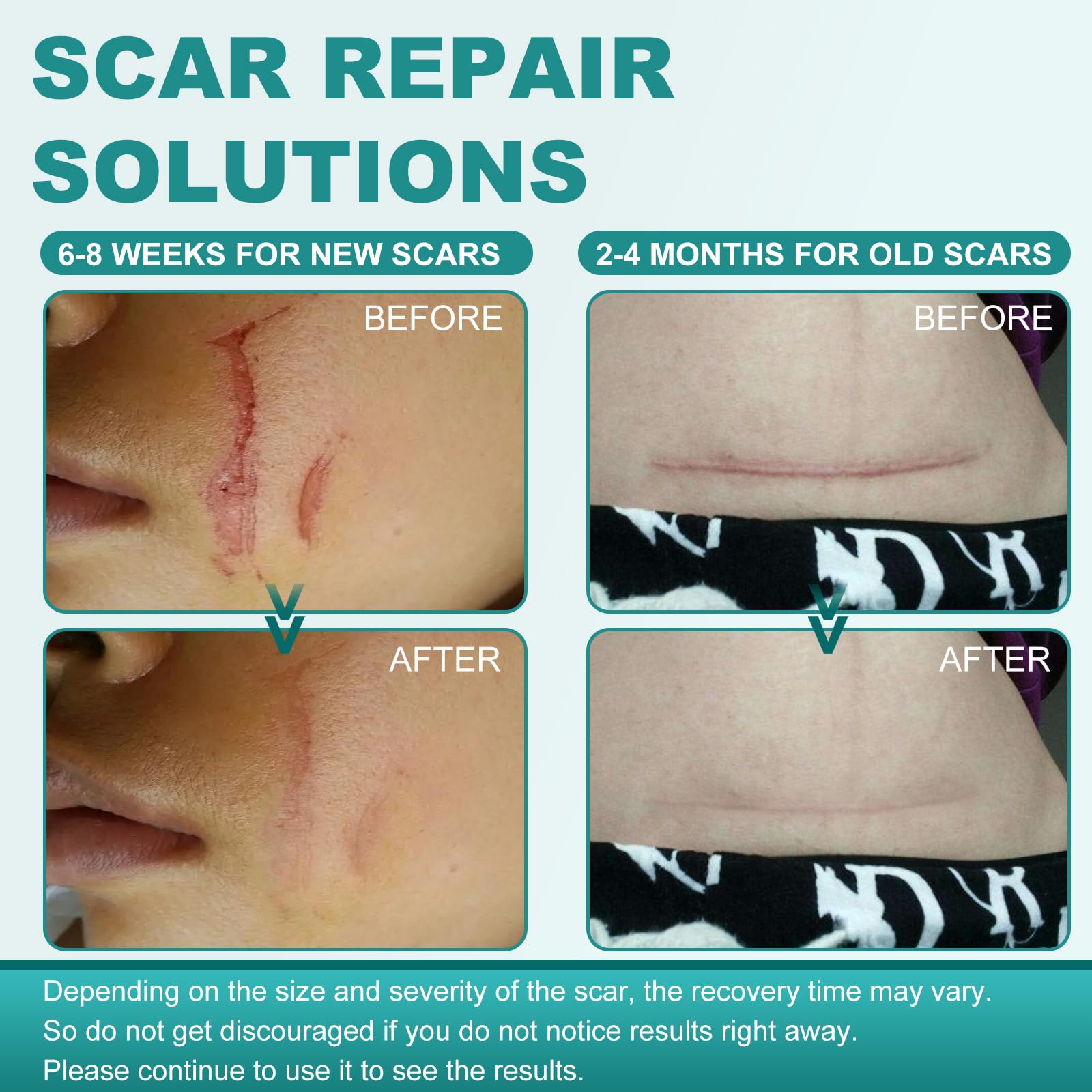 Nullam scar tape on skin during use—gentle pressure to flatten texture over time.