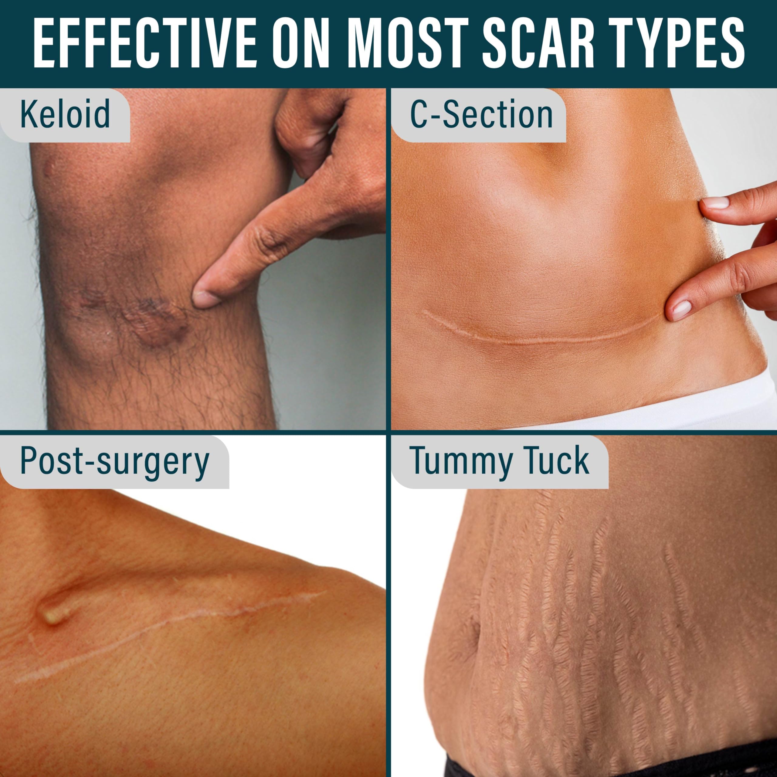 NUVADERMIS soft breathable scar tape conforms to skin contours