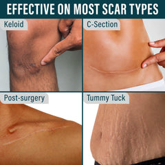 NUVADERMIS soft breathable scar tape conforms to skin contours