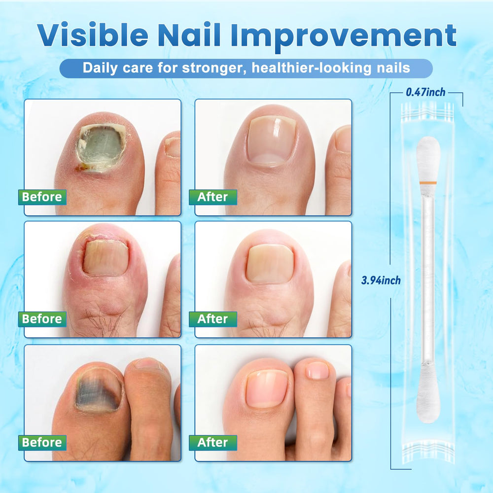ONIADBA fungal-nail-swabs-packaging indicates 100 treatments for family care.