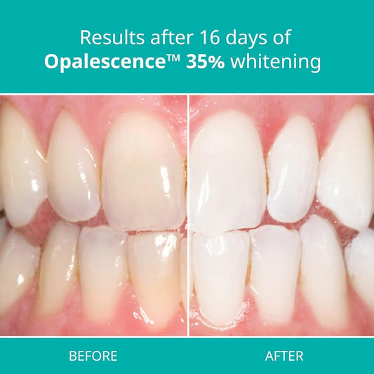 Close-up of Opalescence 35% PF whitening gel syringes (4-pack)