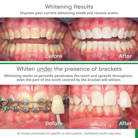 Close-up of prefilled whitening trays showing gel strips