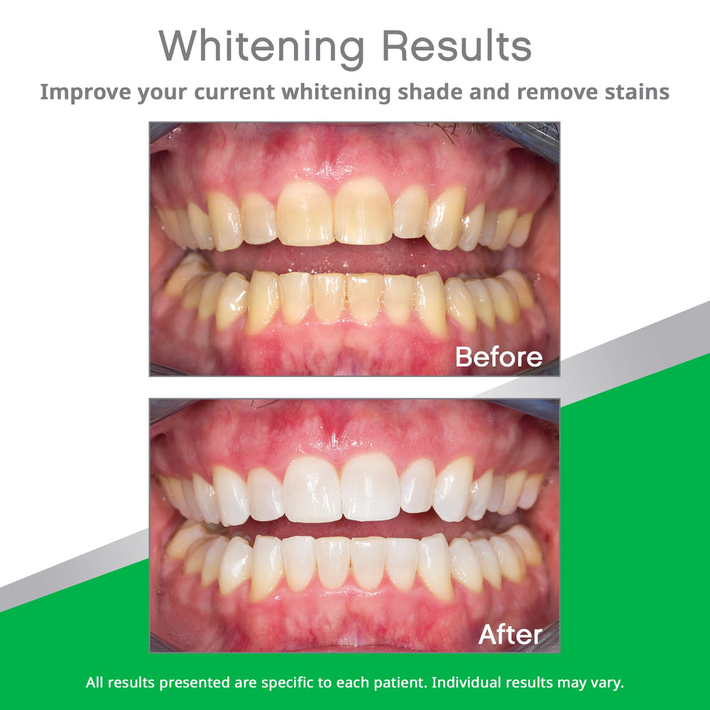 Mint flavor Opalescence Go trays by Ultradent