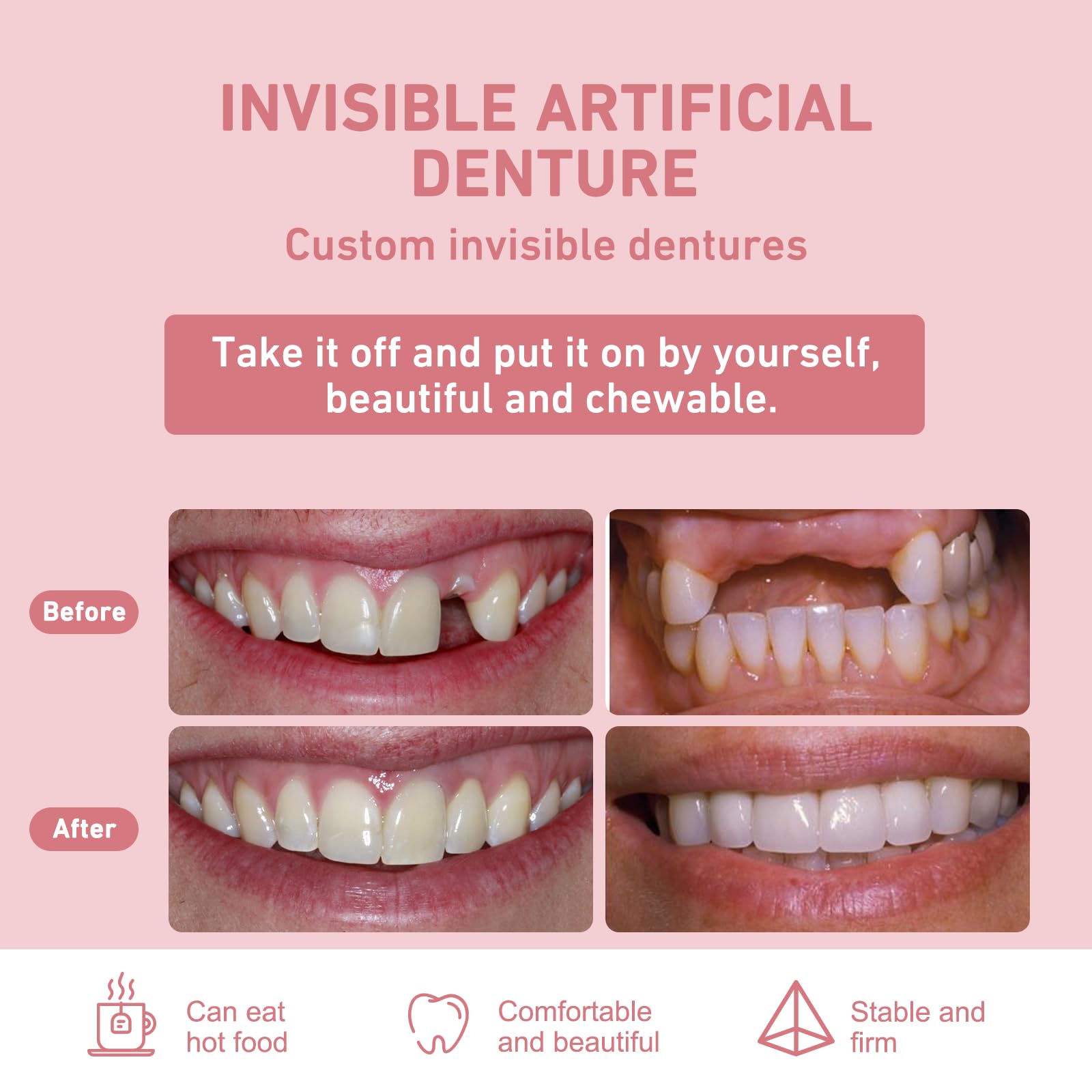 Removable partial dentures for easy daily cleaning and maintenance