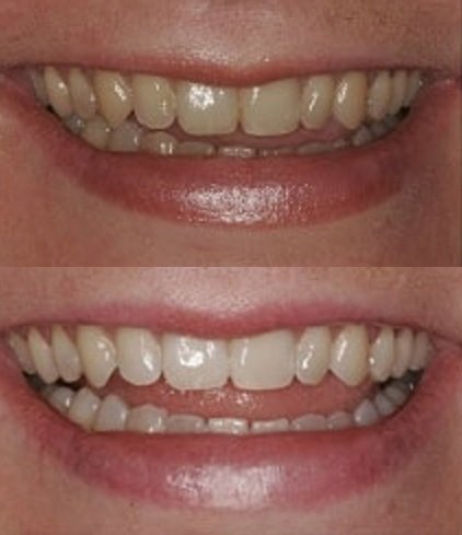 Close-up of a 3ml ProDental whitening gel syringe