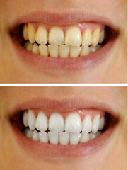 Professional-grade teeth whitening gel components