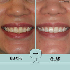 Before and after whitening with Prostrips