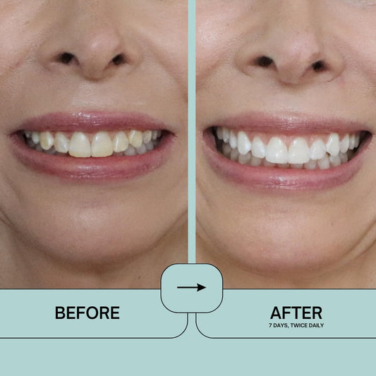 Close-up of Prostrips whitening strips on teeth