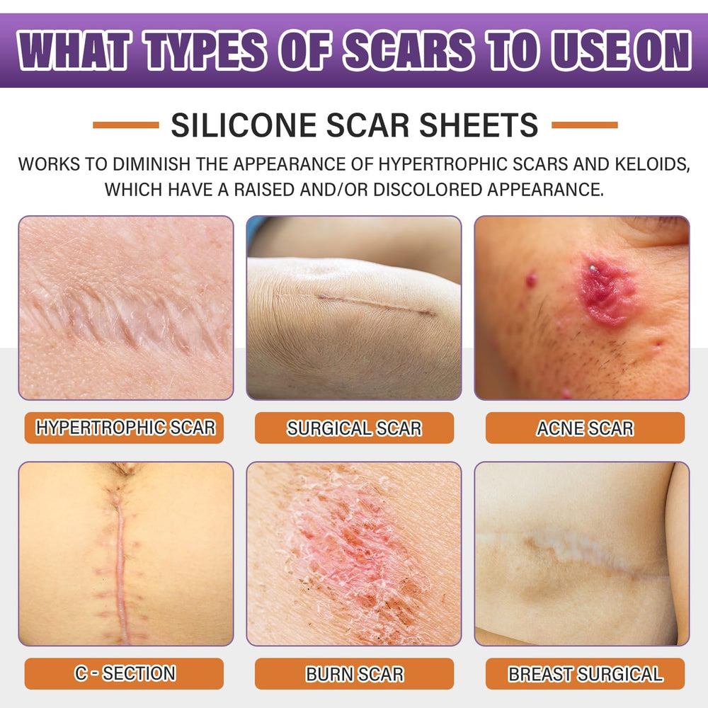 Psecici silicone scar sheets cut-to-fit demonstrate customizable coverage for various scar sizes