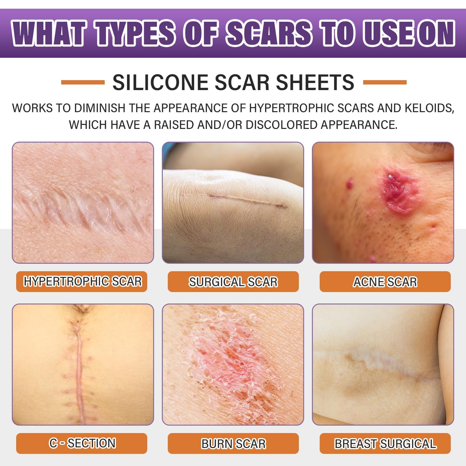 Psecici silicone scar sheets roll cut-to-fit demonstrates customizable coverage for different scars
