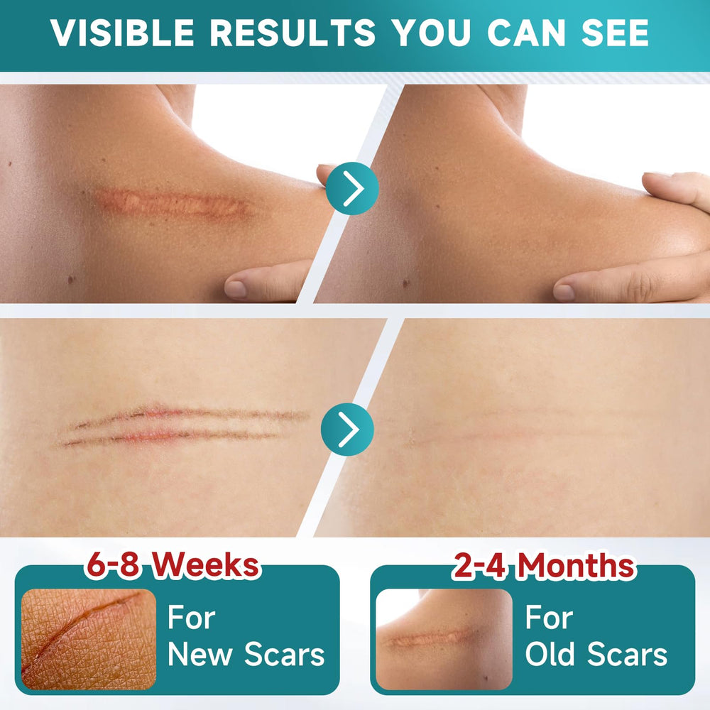 Pumkot silicone scar tape cut-to-size demonstrates easy shaping for diverse scar forms.