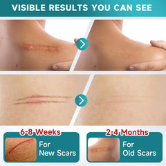 Pumkot silicone scar tape cut-to-size demonstrates easy shaping for diverse scar forms.