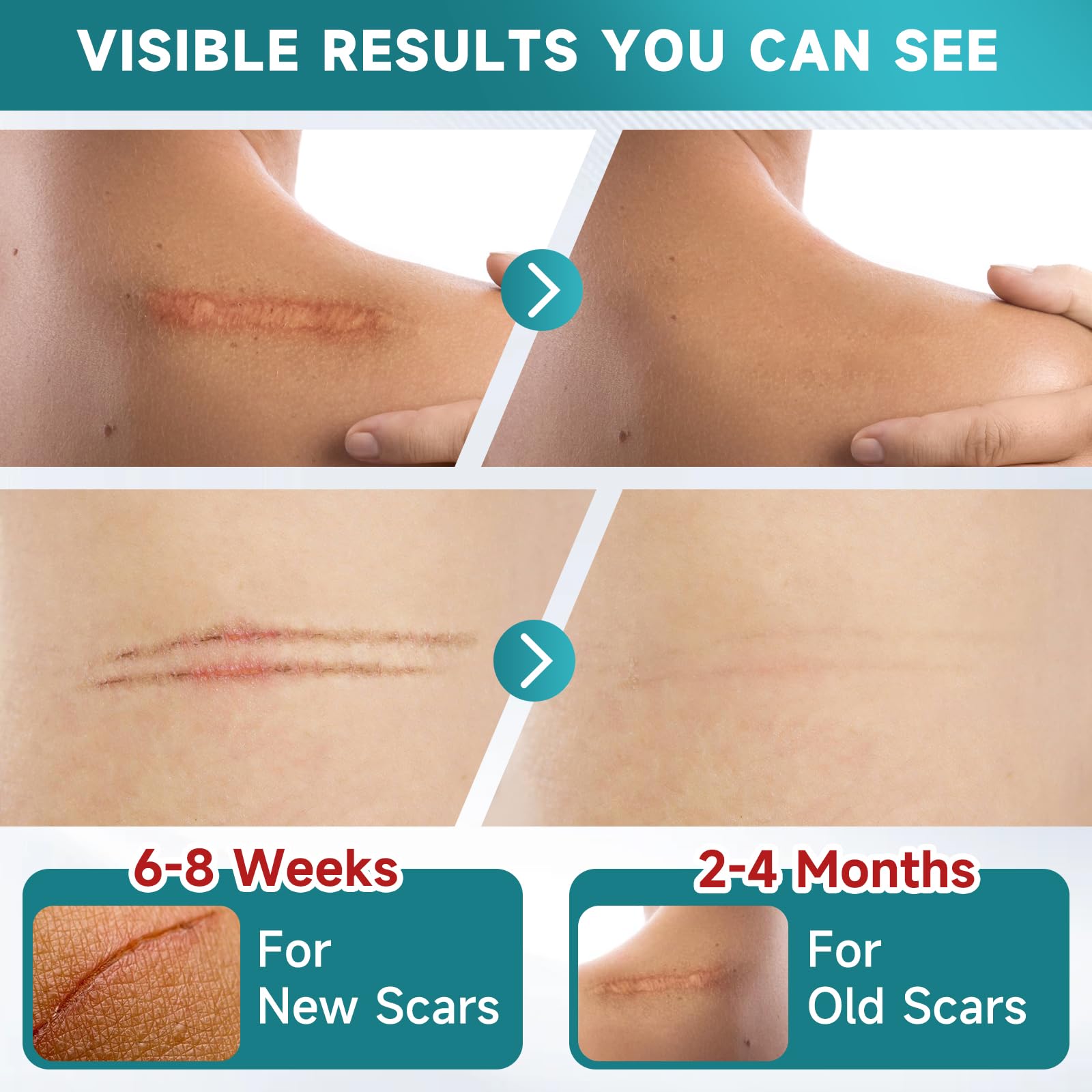 Pumkot silicone scar tape cut-to-size for surgical and burn scars