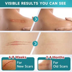 Pumkot silicone scar tape cut-to-size for surgical and burn scars