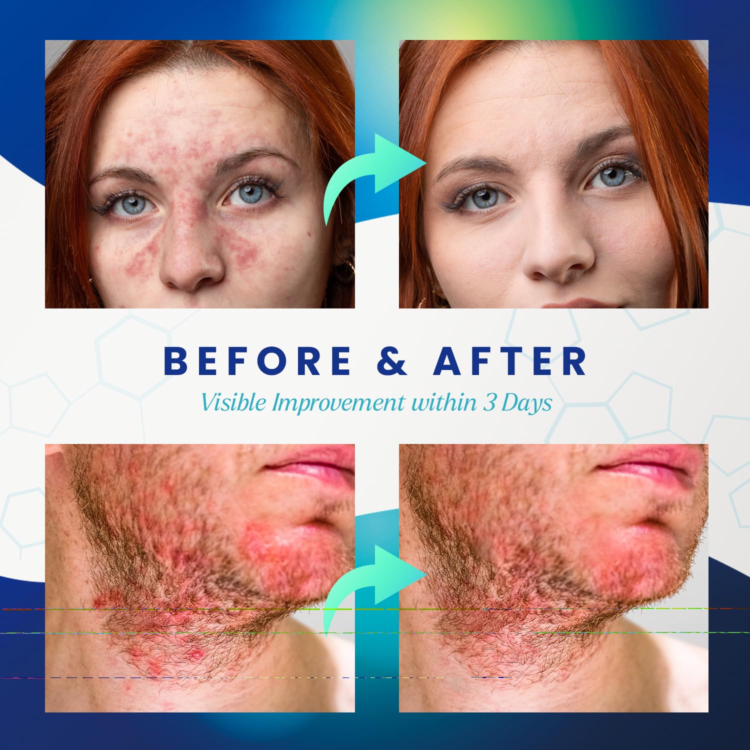 PureSkin-product-packaging-front image builds trust for sensitive-skin users.