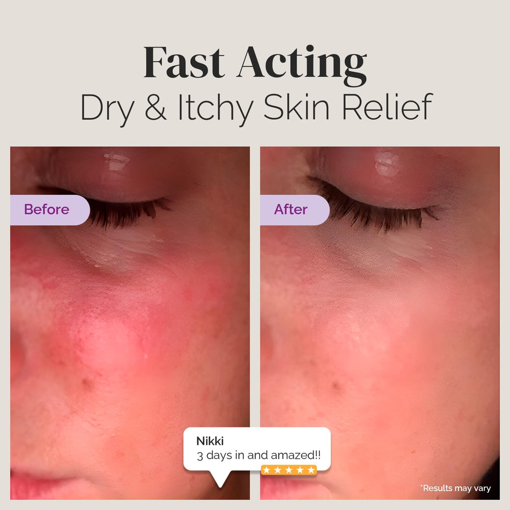 Puriya application on hands demonstrates ease of use for dry itchy skin