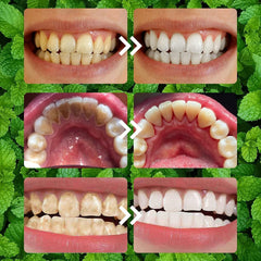 Remineralization concept for teeth and gums