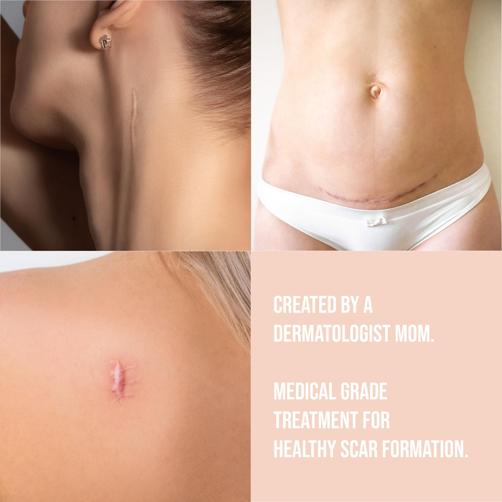 Quitch silicone scar sheets on the skin of the abdomen after a C-section.