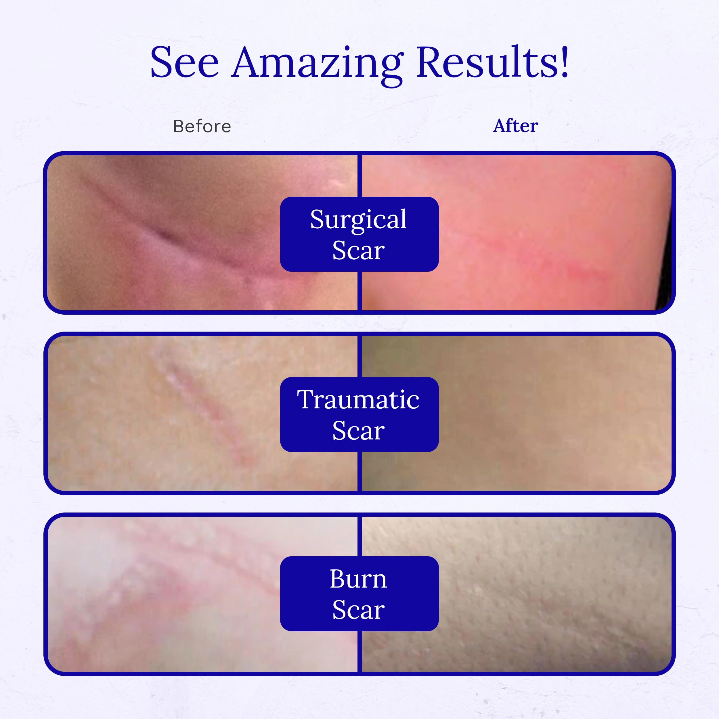 Rejuvaskin RejuvaSil burn-area demonstrates use on burn scars.