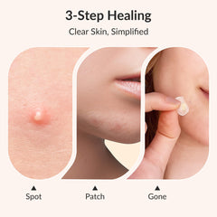 RPE Life Korean Pimple Patches advanced 15mm covers larger breakout