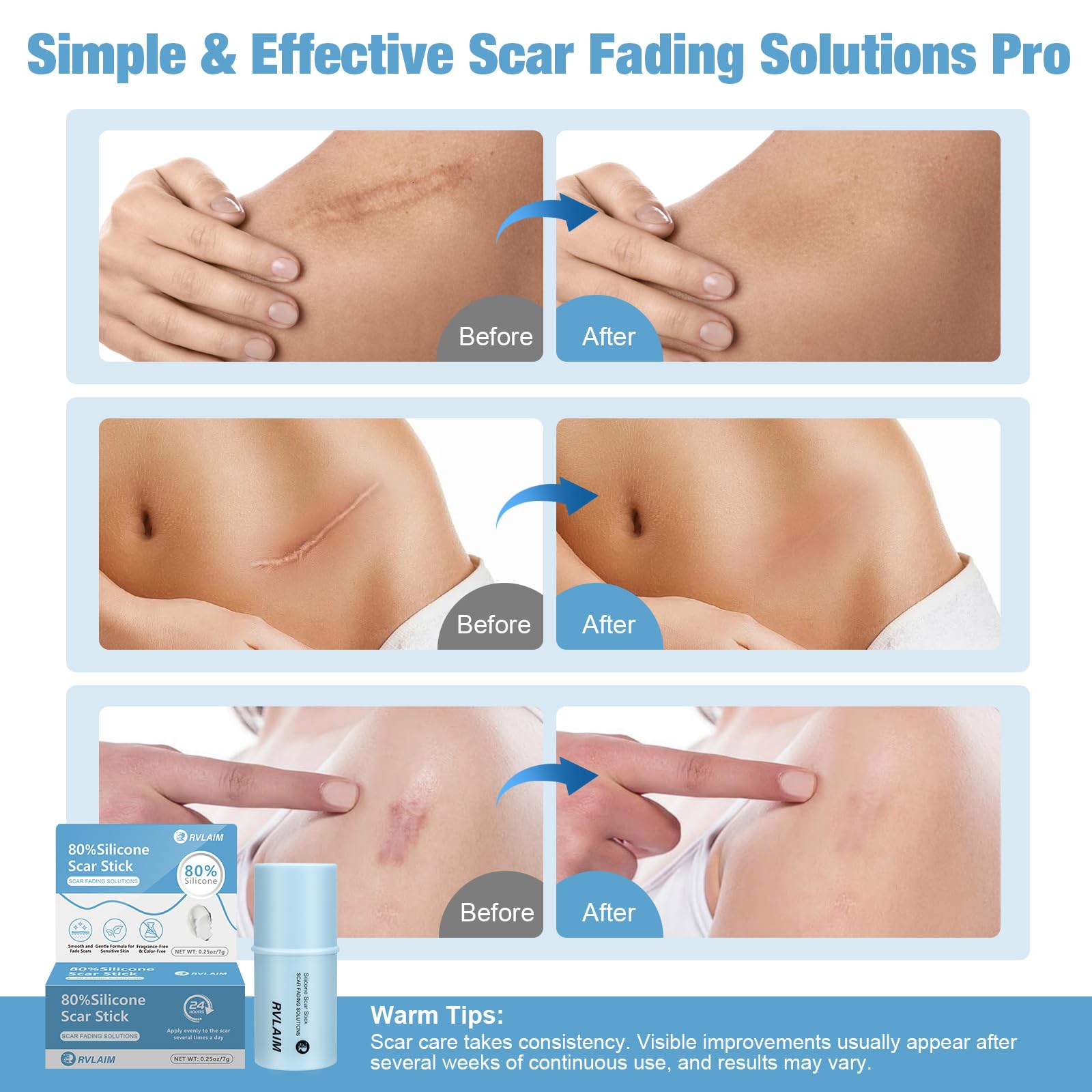 Rvlaim Silicone Scar Stick on surgical scar demonstration