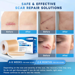 Rvlaim silicone scar-tape surgical-scar displays slim, discreet daily wear