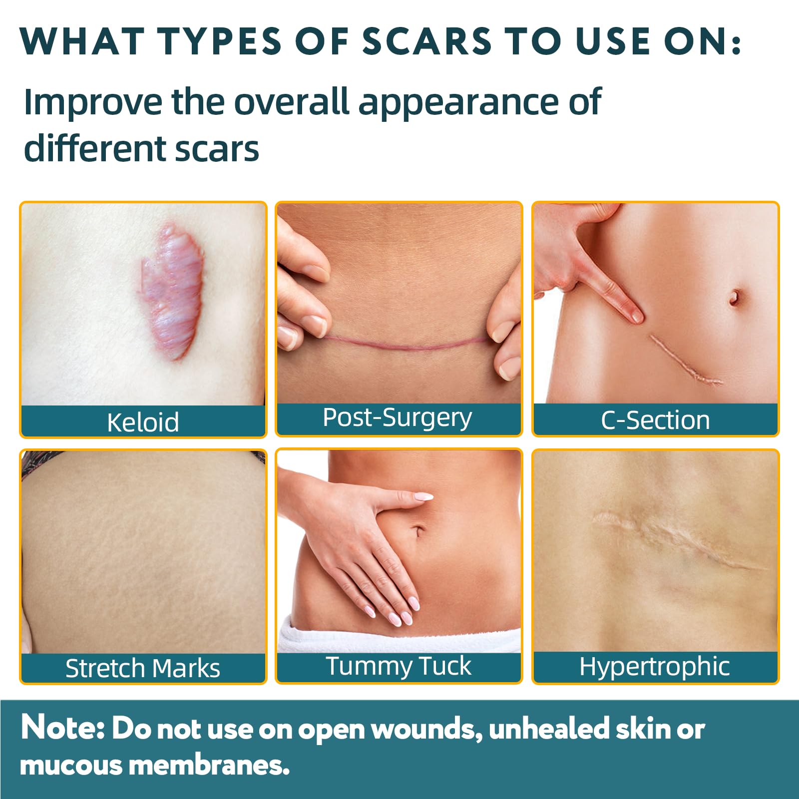RWT silicone scar sheets being applied to a scar area for discreet wear.
