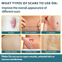 RWT silicone scar sheets being applied to a scar area for discreet wear.