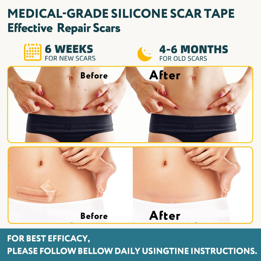 RWT silicone scar sheets closeup showing smooth film and flexible fit.