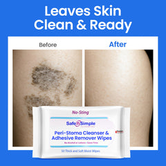 Safe n’ Simple wipe for bandage and tape removal