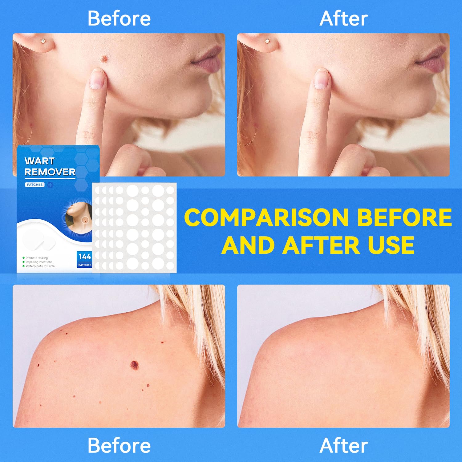 SAKIMA patch covers wart area discreetly while you wear everyday clothes