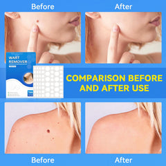 SAKIMA patch covers wart area discreetly while you wear everyday clothes