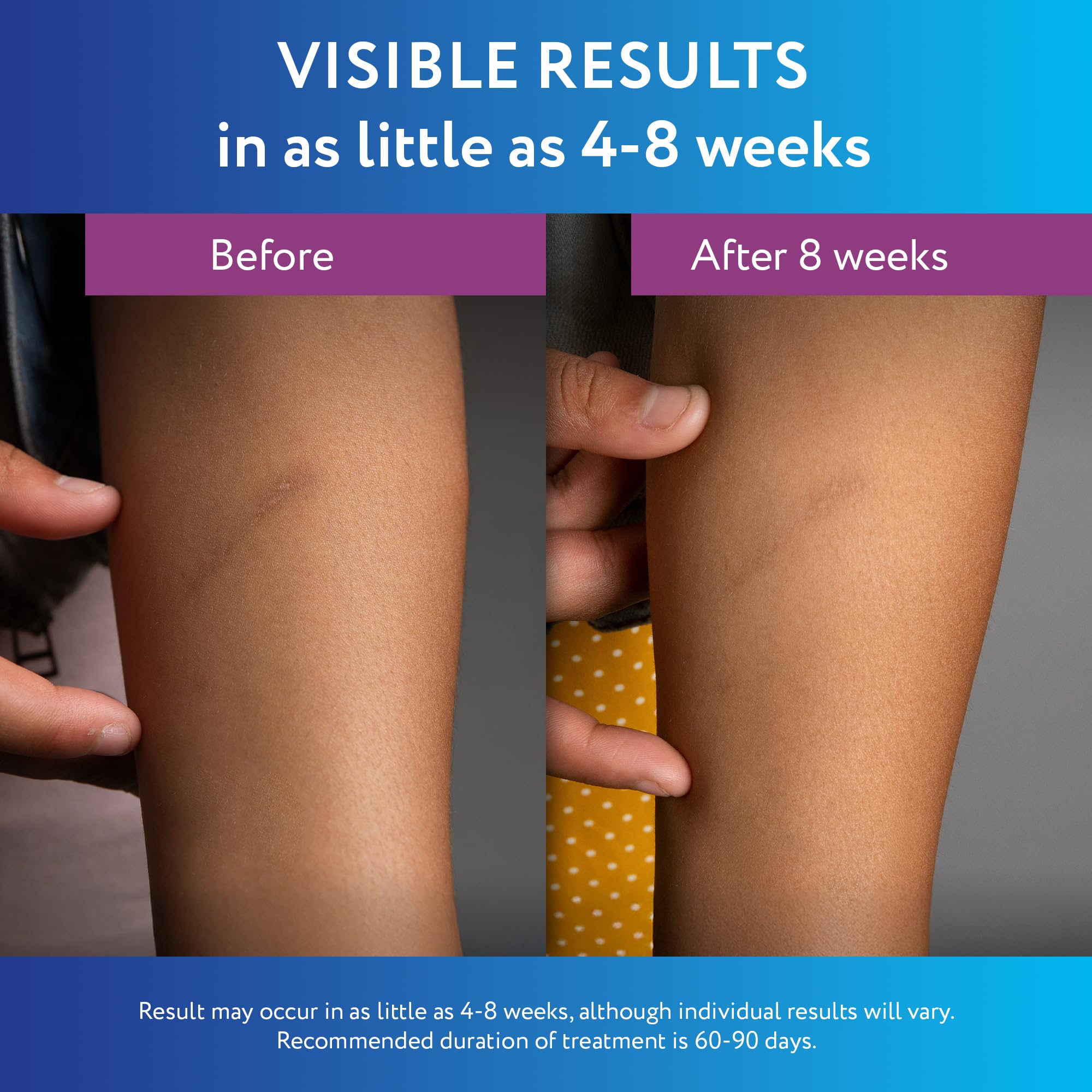 ScarAway bottle dispensing a small amount for targeted scar treatment