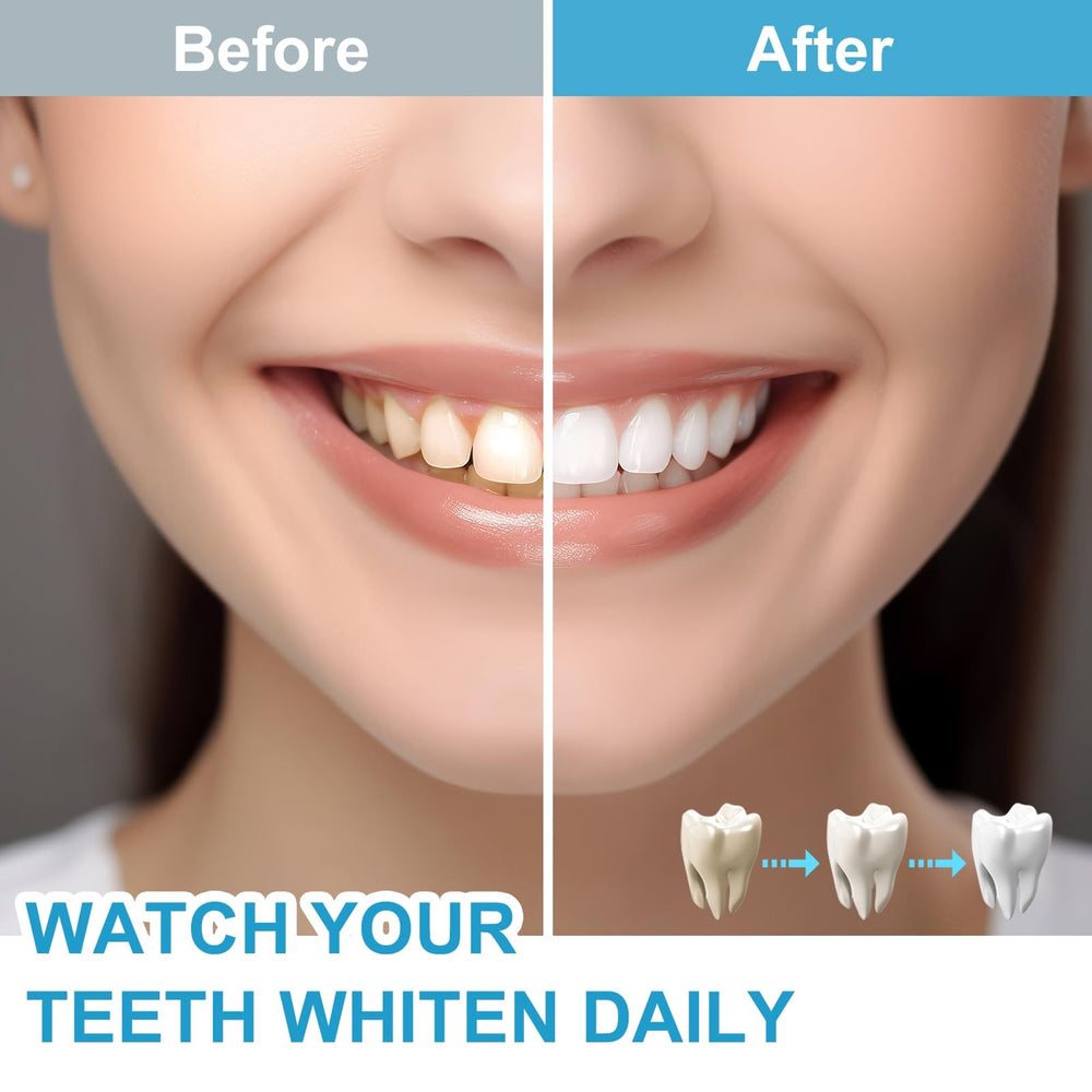 Dental trays included in the Sensitive Teeth Whitening Kit