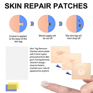 SHISUIZHE precision tip enabling targeted skin tag removal