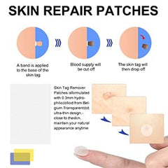 SHISUIZHE precision tip enabling targeted skin tag removal