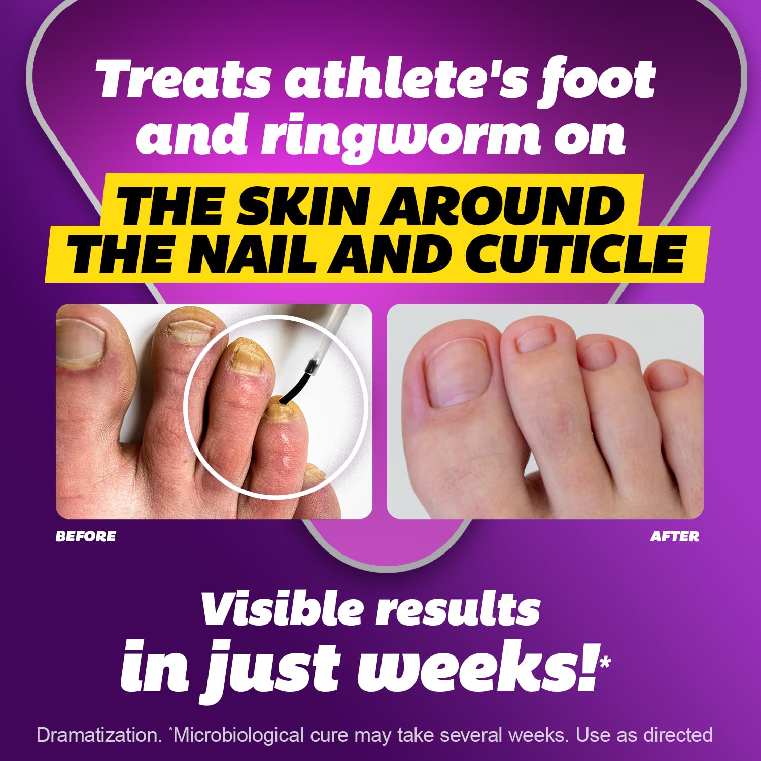 Close-up of Silka bottle with Tolnaftate 1% for toenail care.
