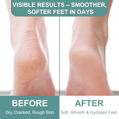 60% Urea Cream for Feet Aloe vera soothing barrier support