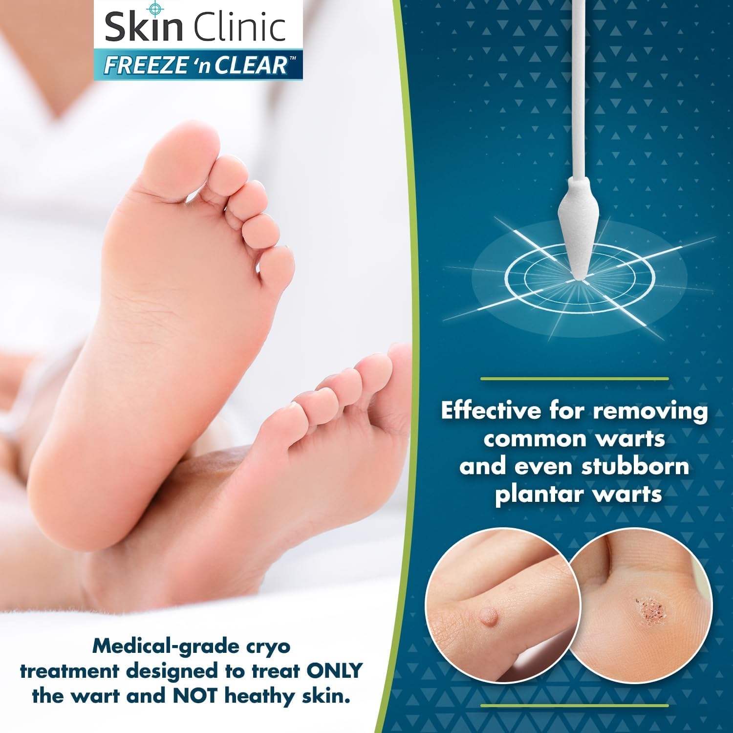 Chemical-free freezing with Skin Clinic Freeze 'n Clear supports natural wart removal.