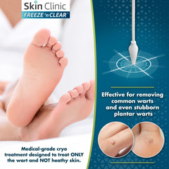 Chemical-free freezing with Skin Clinic Freeze 'n Clear supports natural wart removal.