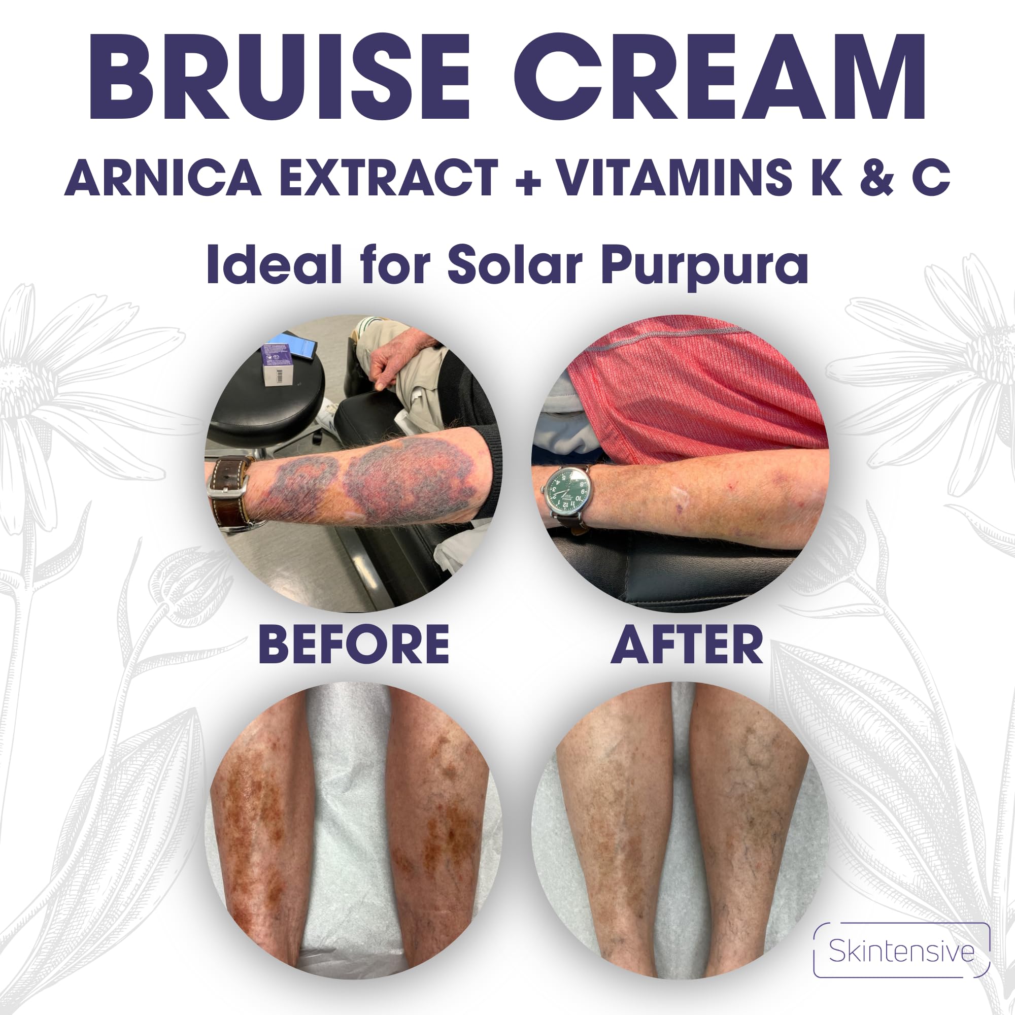 Skintensive Arnica Bruise Cream coconut-oil base shown for smooth, nourished skin.