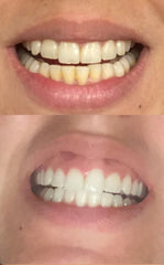 Four syringes of Smile Titan Whitening Gel with 44% carbamide peroxide