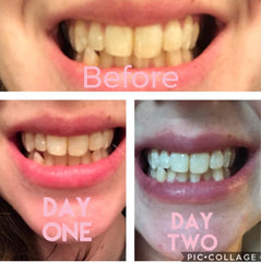LED whitening light device included with Smile Titan kit