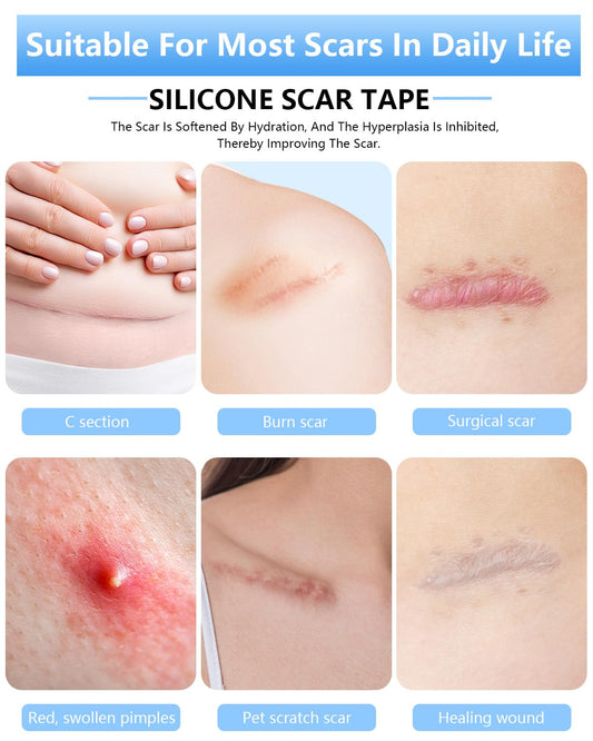 Somlzu silicone scar sheets soft texture hugs body contours