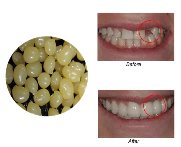 Packaged Sowsmile 4-color beads kit for teeth repair