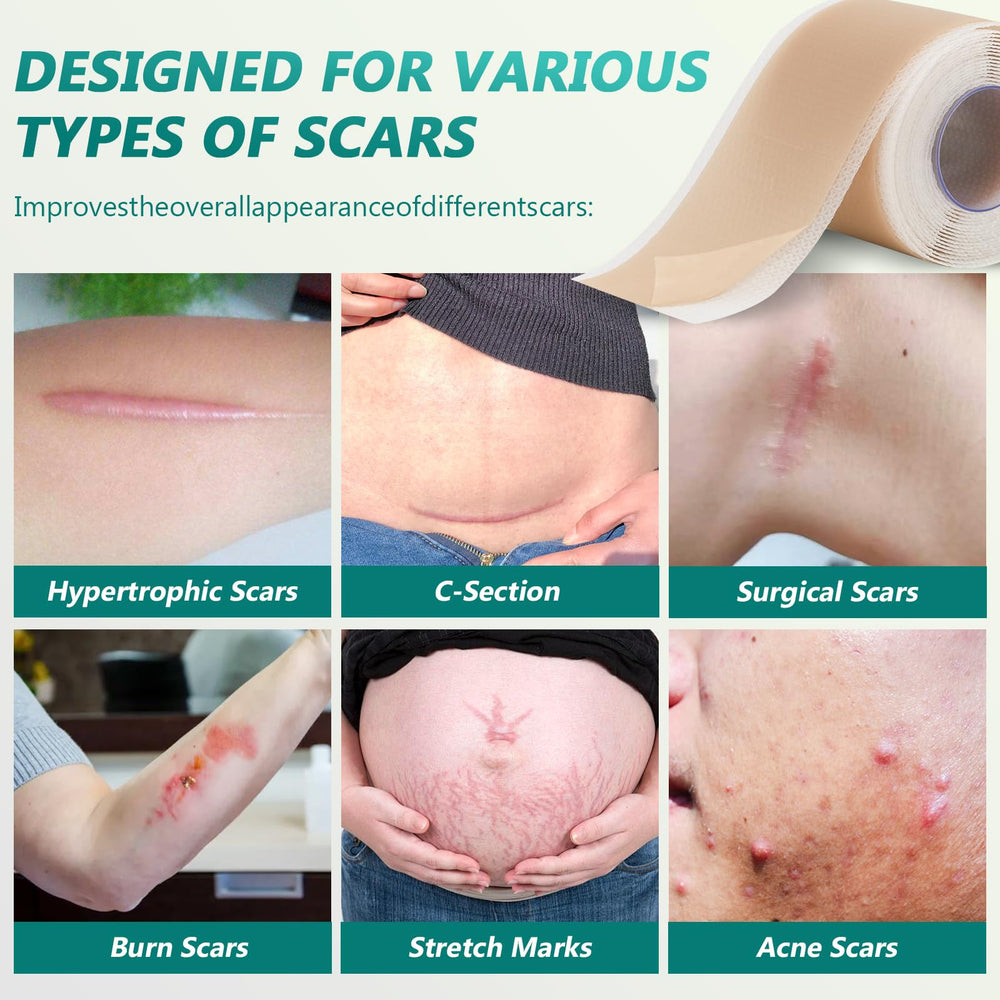 SUCONBE silicone scar tape easy-tear design enables quick trimming without scissors