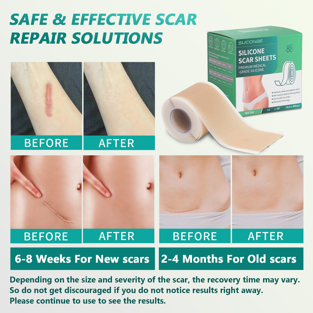 SUCONBE silicone scar tape applied on skin for discreet scar coverage