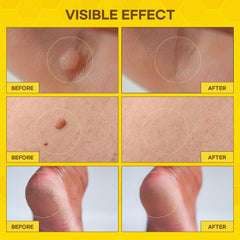 SupreH fast-acting freeze-off targets warts quickly for convenience.