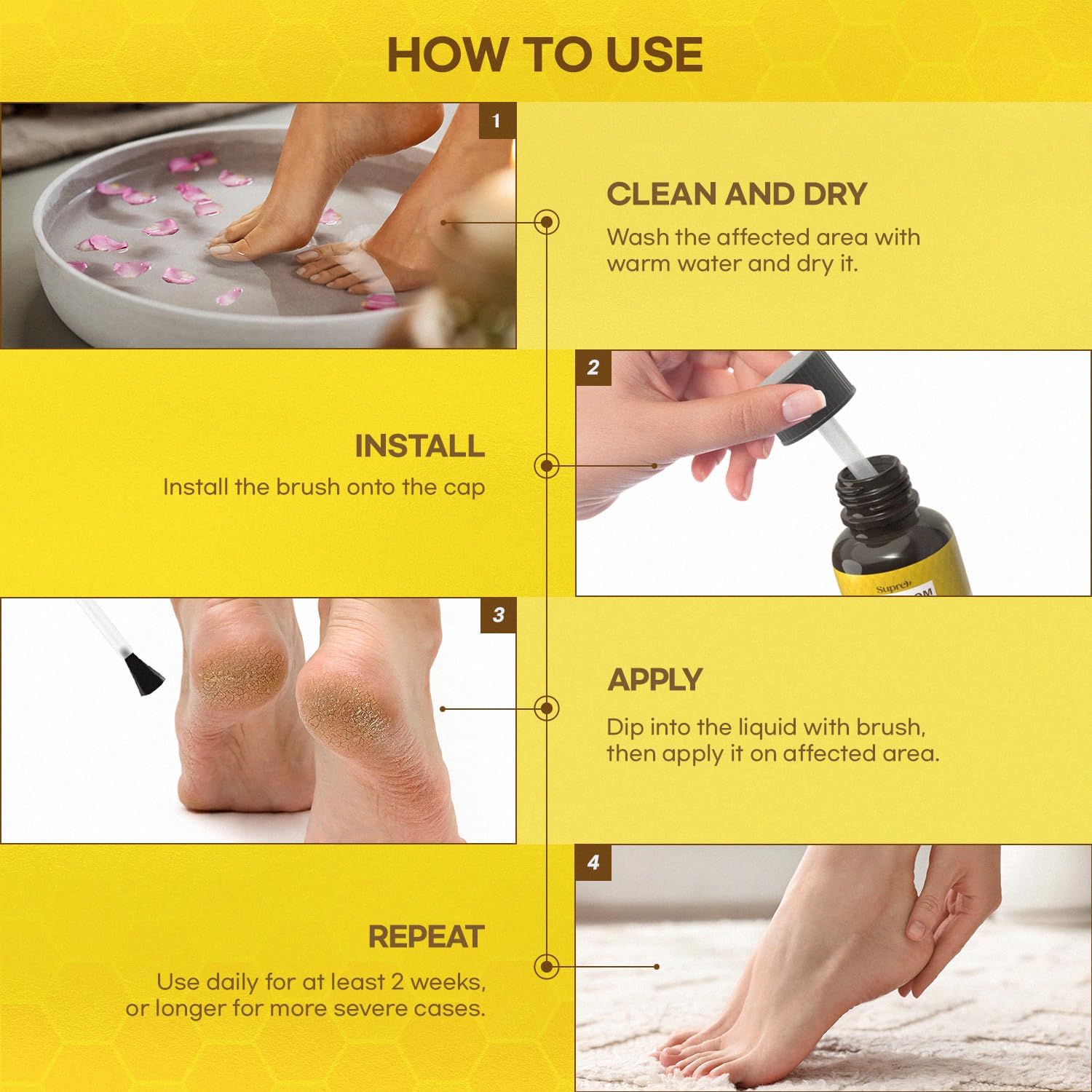 SupreH wart remover for genital-area care with soothing properties.