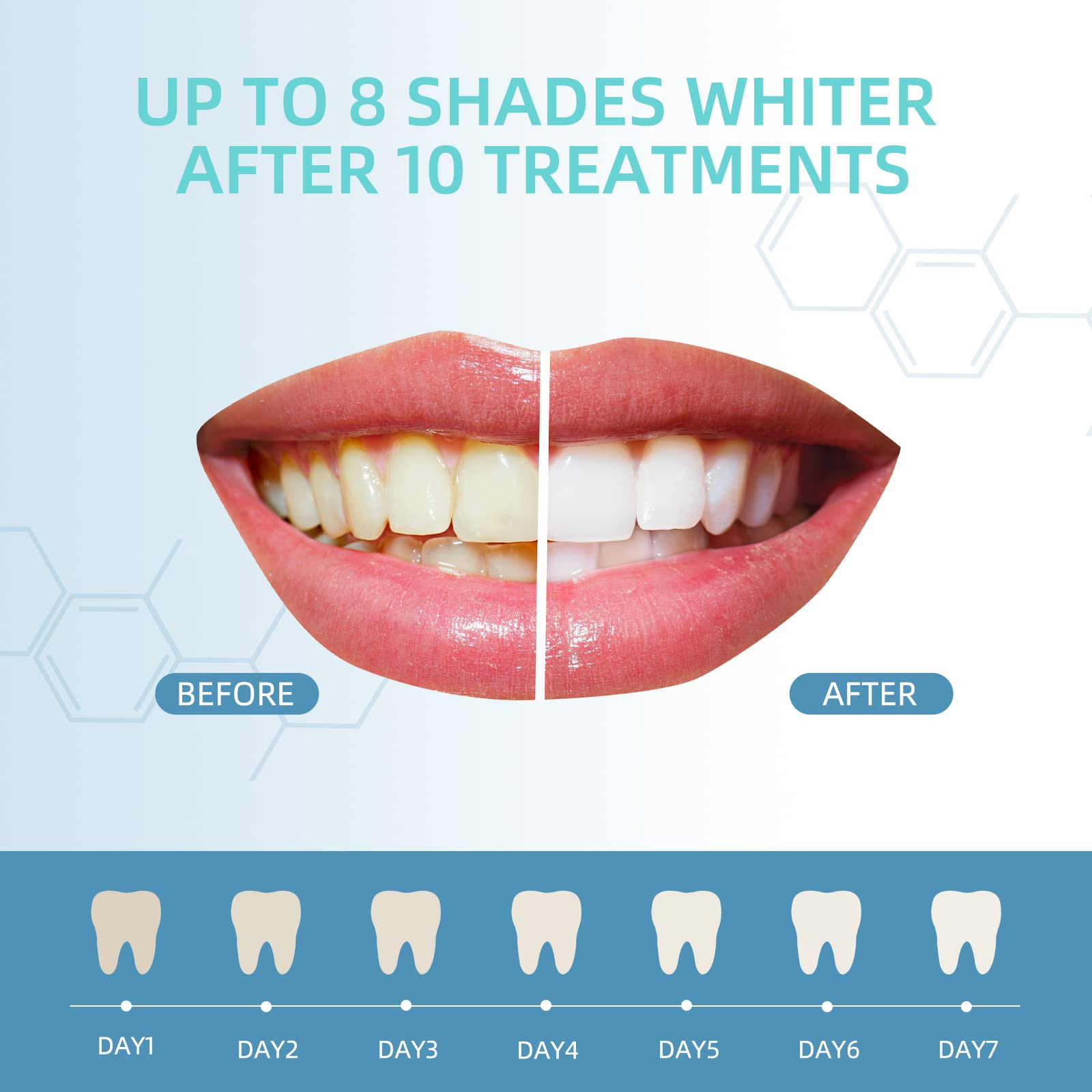 Before and after results with whitening gel refills